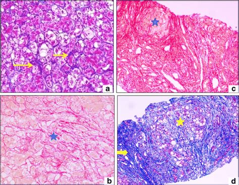 Perisinusoidal fibrosis stage.  Histologic features may overlap, especia...