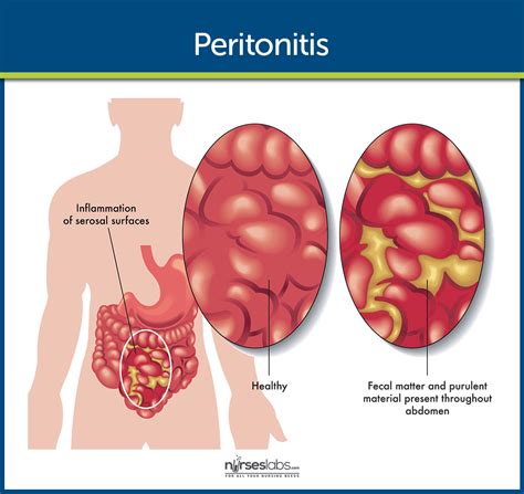 Peritonit behandling