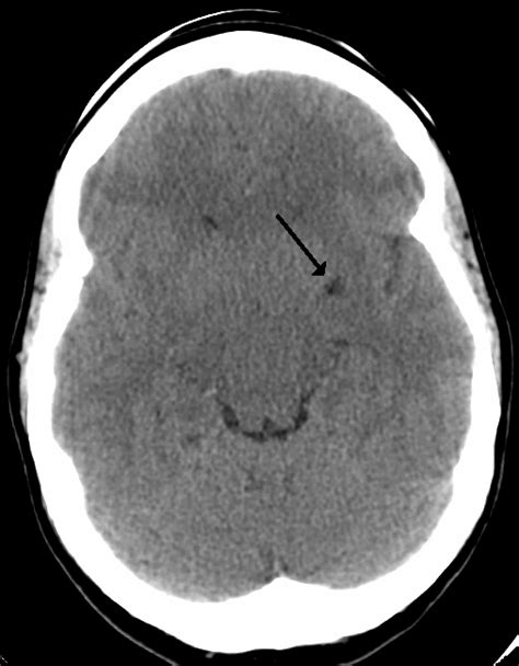 Perivascular space Wikipedia.