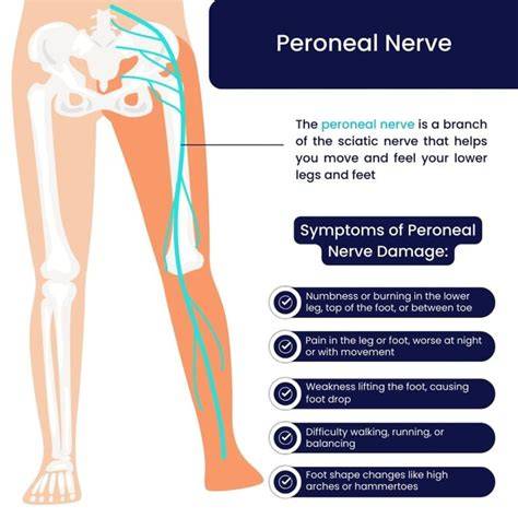 Peroneal nerve damage settlement.  Nerve damage victims may be entitled to com...