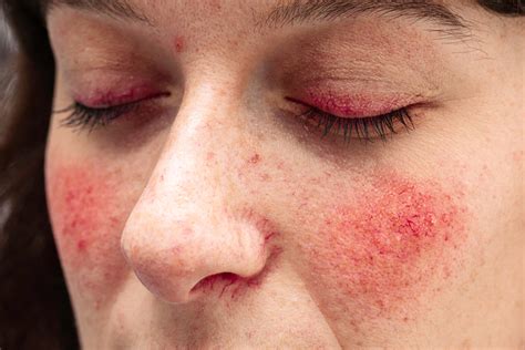 Persistent Red Rash on Cheeks: Doctor E…