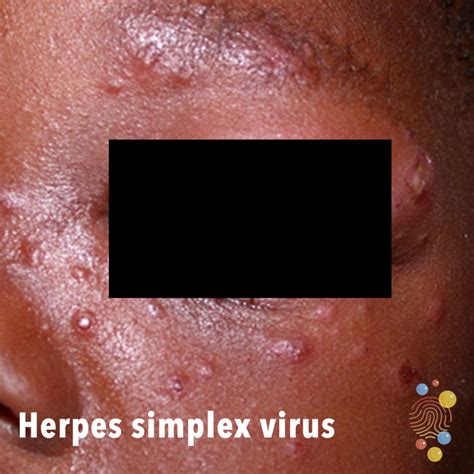 Persons with herpes simplex virus type 2, but without