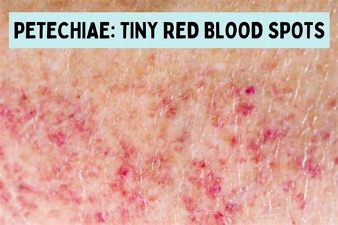 Petechiae Is An Indicator Of