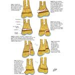 Peterson Classification of Physeal Fractures - Netter Images