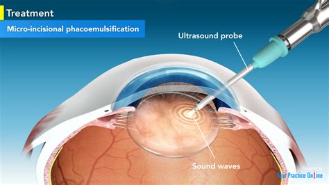 Phacoemulsifcation Sys, Cataract Extract W9114F15T0058