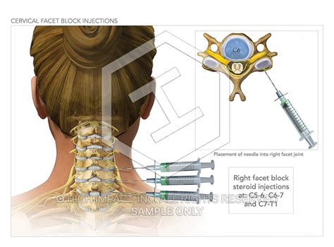 Phenol nerve block injections HealthTap Online Doctor