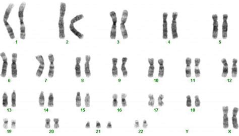 Phenotypes Associated with Down Syndrome and Causative Genes