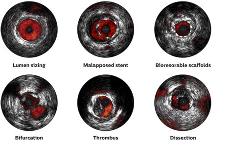 Philips Volcano ChromaFlo imaging Philips