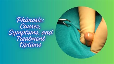 Phimosis - Symptoms, Causes and Cure - TabletWise.com