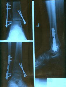 Phoenix Broken Bone & Fracture Attorney Abels & Annes, P.C.