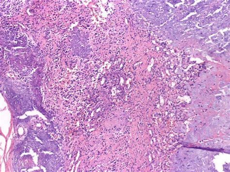 Phosphaturic mesenchymal tumors: what an endocrinologist …