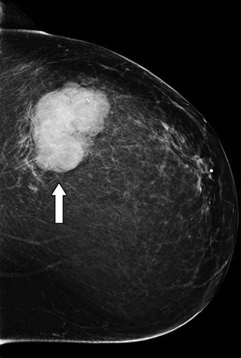 Xxxvidosmovi - th?q=Phyllodes benign breast tumor