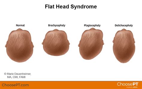 Physical Therapy Guide to Flat Head Syndrome: Plagiocephaly ...