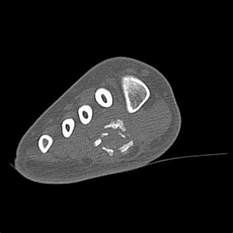 Physiologic periostitis Radiology Reference Article Radiopaedia.org