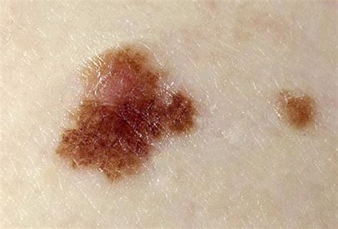 Picture of Dysplastic Nevi (Atypical Moles) Close-Up - WebMD