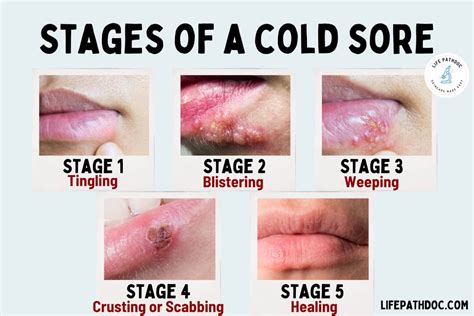 Picture of Oral Health Problems – Cold Sores (Herpes Blisters)