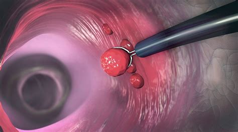 Discover the hidden dangers - a shocking look inside the colon with the image of a polyp