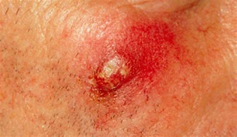 Boils are painful, red, pus-filled lumps on your skin caused by an infection of hair follicles. One infected hair follicle is called a furuncle, and a group of infected follicles joined together is known as a carbuncle. Boils can occur anywhere, but most often in hairy areas that sweat or rub, such as your: face or neck. armpits. groin or vagina.. 