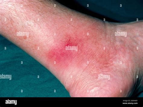 Pictures of cellulitis on ankle.  Cellulitis is a bacterial infection that en...