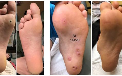 Pictures of dying plantar warts. All the great pictures and videos you would want to about the dreaded wart. 