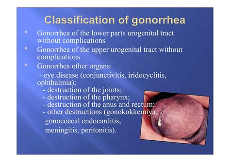 Pictures of oral gonorrhea.  The eye, anus, rectum, Find 3+ Thousand Gonor...
