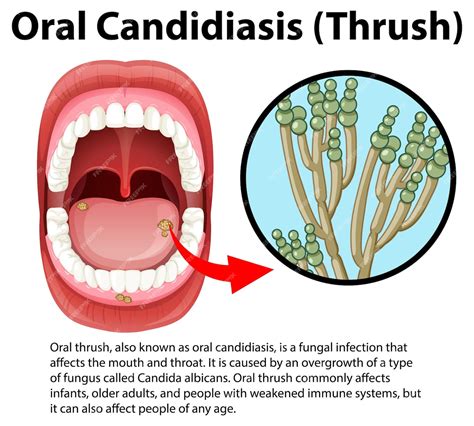 Pictures of oral thrush.  Thousands of new, high-quality Oral Candidiasis (T...