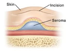 Seromas vs. Other Lumps. Many people mistake seromas for other fluid-filled lumps. The could be mistaken for hematomas, which contain red blood cells, or abscesses, which contain pus and develop due to infection. The serous fluid within a seroma is different from lymph, though they appear similar. Iuliia Mikhalitskaia / Getty Images. 