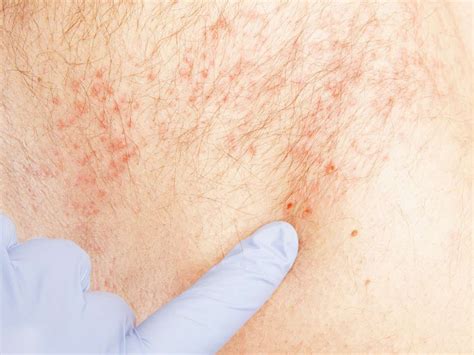 Pictures of shingles in groin area. The red rash might be seen in the groin, armpits, under the belly or breasts, buttocks, neck creases, or between the toes. While the following fungal skin infections are most often caused by dermatophytes (fungi that feed off keratin, the building blocks of skin, hair, and nails), it is possible for an overgrowth of Candida to produce these ... 