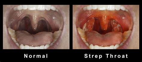 Pictures of strepp throat.  Explore Authentic, Photos Of Strep Throat Stock Ph...