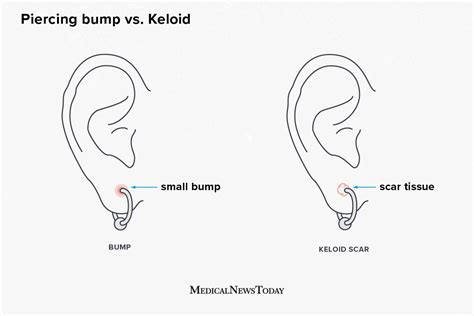 Piercing bump vs keloid.  Learn the differences between piercing bumps and keloid...