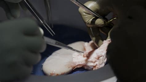 Pig kidney works in donated body for over a month, a step toward animal-human transplants