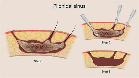 Pilonidal sinus treatment in ayurveda.  Rated 5.  Abstract Pilonidal sinus disease i...