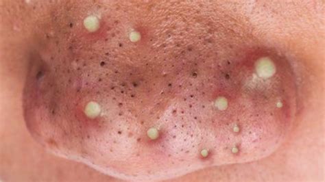 Pimple and blackhead videos. Things To Know About Pimple and blackhead videos. 