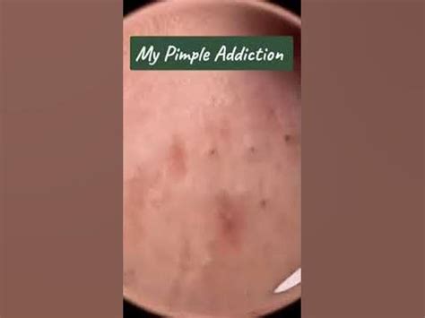 Pimple explosion compilation. Some people may experience a sense of satisfaction or relief when they pop a pimple, as it can provide temporary relief from the pressure or discomfort assoc... 