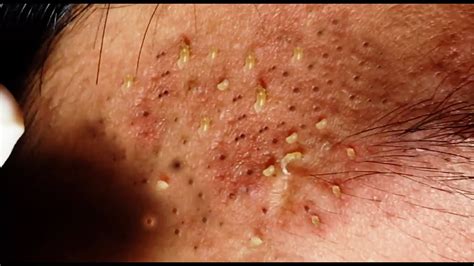 By Sarah Felbin Published: Jun 25, 2021. Dr. Pimple Popper just posted a brand new milia popping video on Youtube. In the video, she squeezes super stubborn milia on eyelids and all around a ....