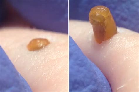 Pimple popping blackheads close up. On Sunday, Dr. Pimple Popper posted a new Instagram video showing the removal of a blackhead hidden on the backside of a patient's ear. More than one million overjoyed fans have watched it so far. 