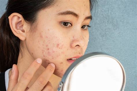 Pimple with hard white seed treatment. Apr 17, 2023 · For example: Clean the affected area daily. Use a mild soap to prevent skin irritation. Steam open the pores. This can be done by sitting in the bathroom and running a hot shower. Exfoliate the ... 