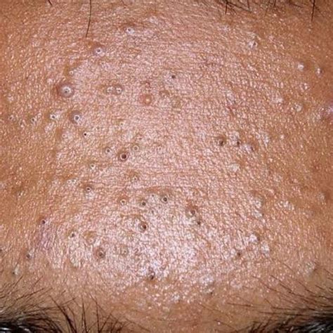 Pin By Codey On Skin Bumps In Comedonal Acne Skin Bumps Acne Scar Removal