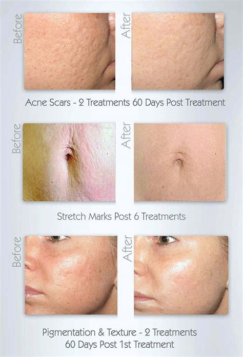 Pin on Before and after