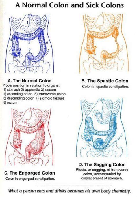 Pin on DIVERTICULITIS