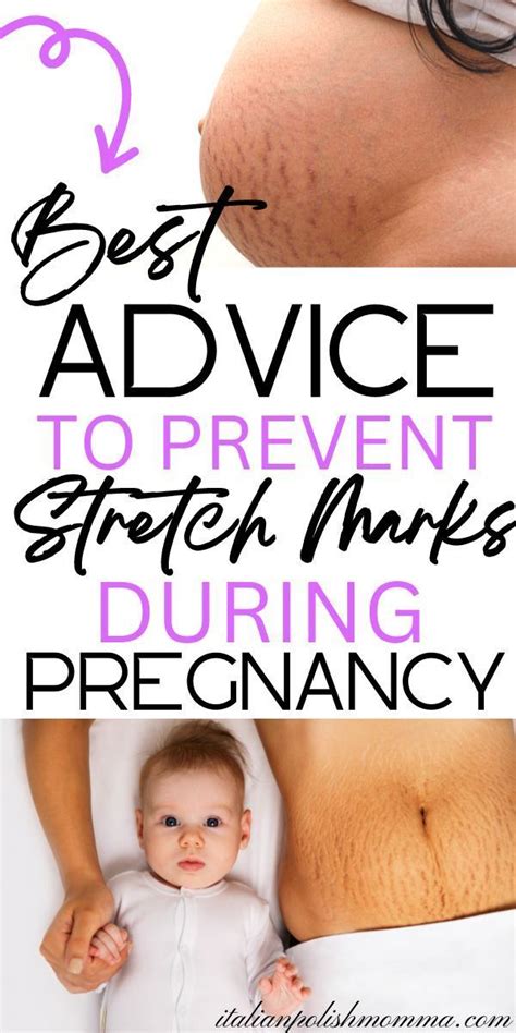Pin on Preventing Stretch Marks