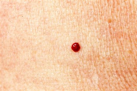 Possible Causes of Pinpoint Red Dots on Skin. 1. Cherry Angioma