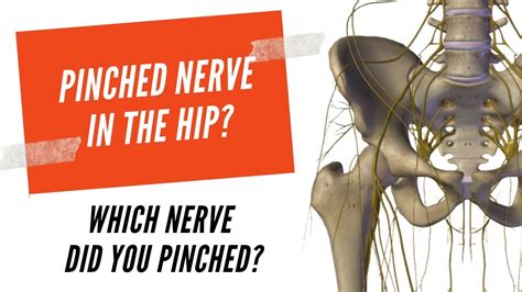 Pinched nerve in hip how to fix