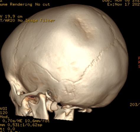 Ping pong skull fracture - ResearchGate