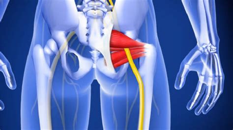 Piriformis Muscle Injection - University of Toledo