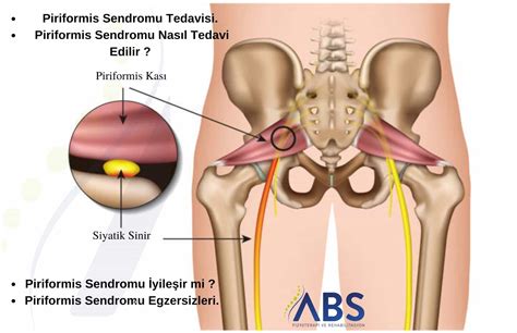 Piriformis Sendromu.