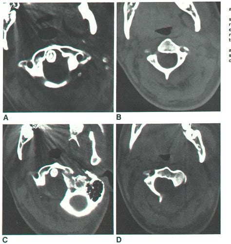 PitfallsintheCTDiagnosis ofAtlantoaxial Rotary Subluxation