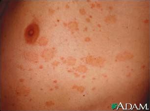 Pityriasis Rosea Encyclopedia.com