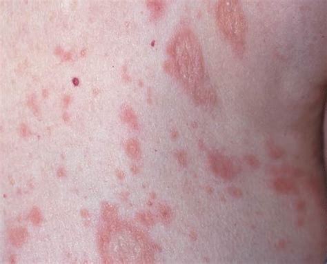 Pityriasis rosea