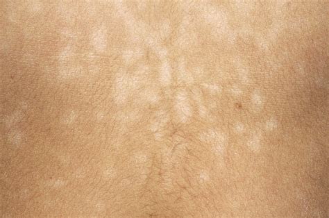 Pityriasis versicolor